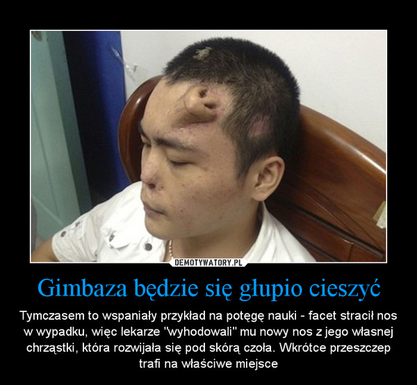 Gimbaza będzie się głupio cieszyć – Tymczasem to wspaniały przykład na potęgę nauki - facet stracił nos w wypadku, więc lekarze "wyhodowali" mu nowy nos z jego własnej chrząstki, która rozwijała się pod skórą czoła. Wkrótce przeszczep trafi na właściwe miejsce 