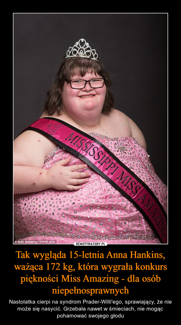 Tak wygląda 15-letnia Anna Hankins, ważąca 172 kg, która wygrała konkurs piękności Miss Amazing - dla osób niepełnosprawnych – Nastolatka cierpi na syndrom Prader-Willi'ego, sprawiający, że nie może się nasycić. Grzebała nawet w śmieciach, nie mogąc pohamować swojego głodu 