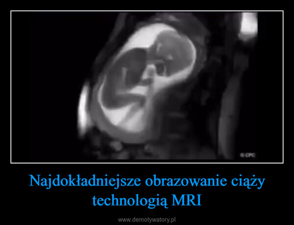 Najdokładniejsze obrazowanie ciąży technologią MRI –  