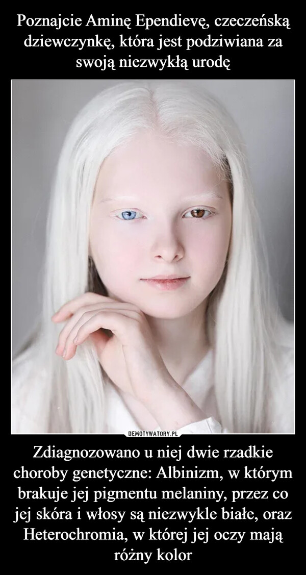 Zdiagnozowano u niej dwie rzadkie choroby genetyczne: Albinizm, w którym brakuje jej pigmentu melaniny, przez co jej skóra i włosy są niezwykle białe, oraz Heterochromia, w której jej oczy mają różny kolor –  